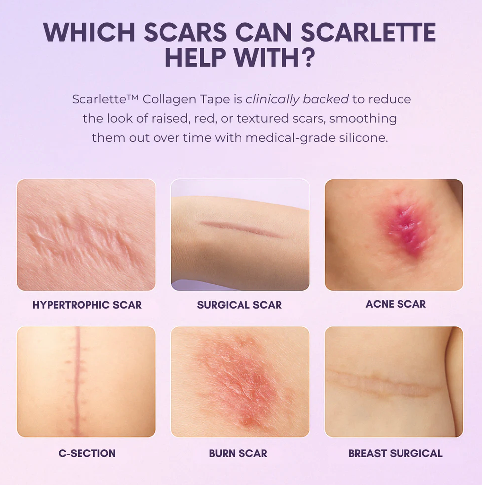 Scarlette - Silicone Scar & Wrinkle Collegen Sheets