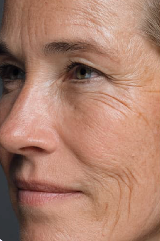 Before wrinkles treatment