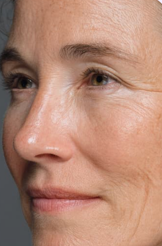 After wrinkles treatment