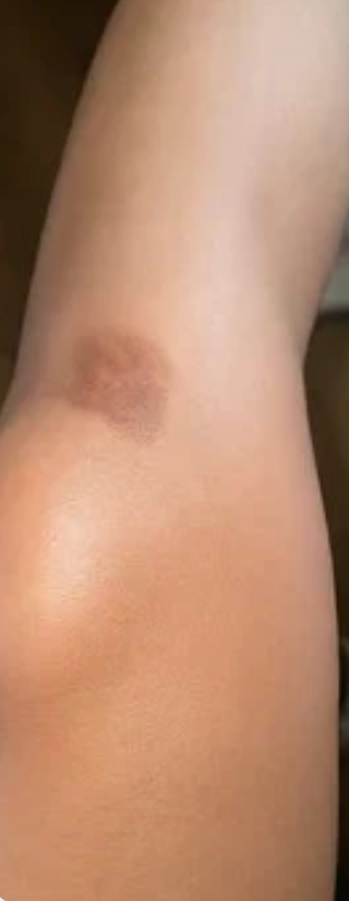 Before scar treatment