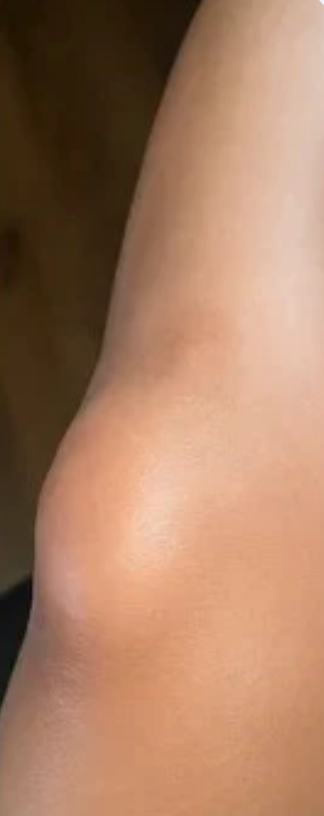 After scar treatment